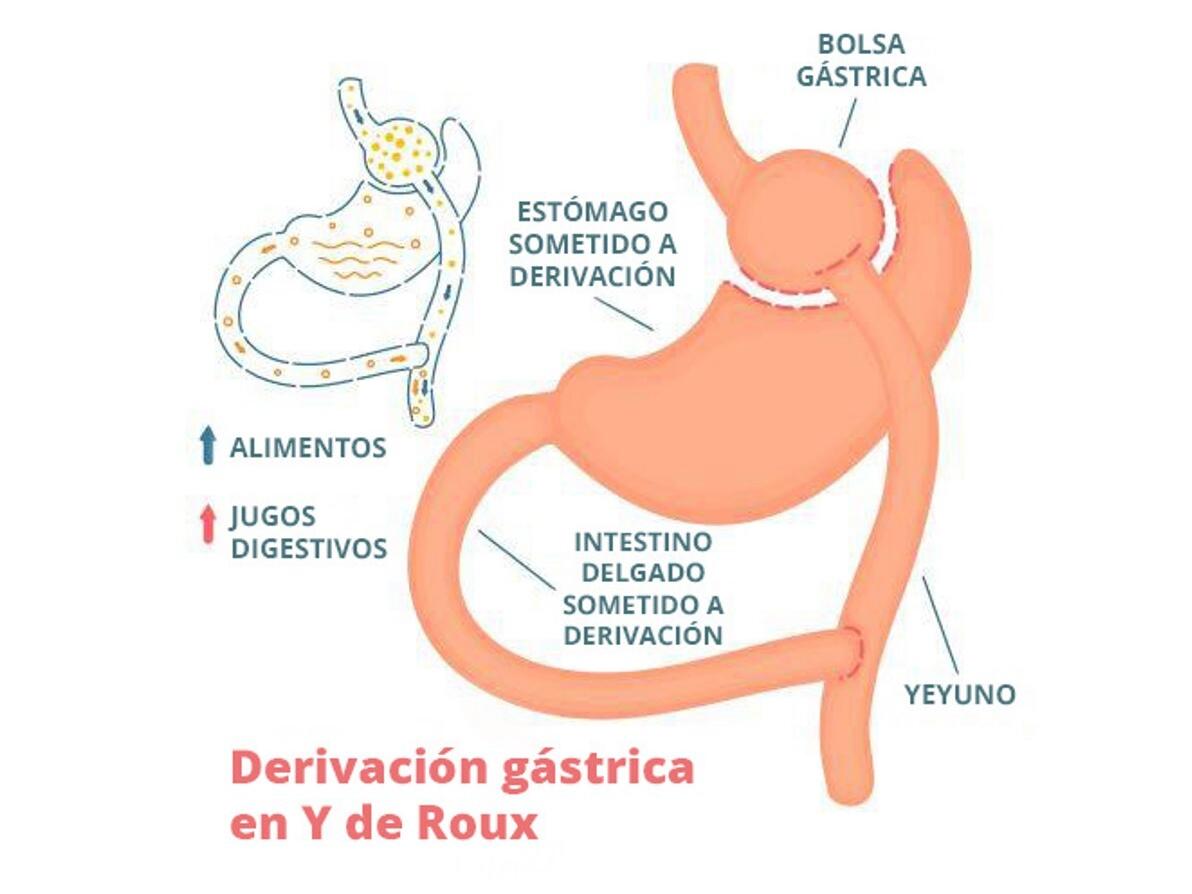 La Cirugía Bariátrica Tal Vez Disminuya El Riesgo De Cánceres Comunes Nci 8927